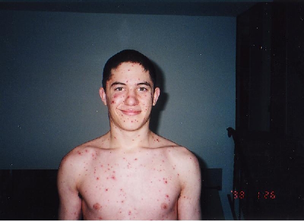 Chicken Pox are sick!