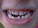 Tooth Knocked Out: Media 2